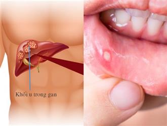 3 dấu hiệu bất thường ở miệng cảnh báo ung thư gan đang âm thầm 'ghé thăm', cần gặp bác sĩ ngay để tránh 'hoạ'