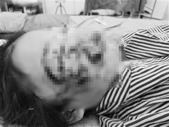 Sang nhà bác chơi, bé gái 10 tuổi ở Tuyên Quang bị chó cắn tổn thương mặt, phải chuyển lên tuyến trung ương