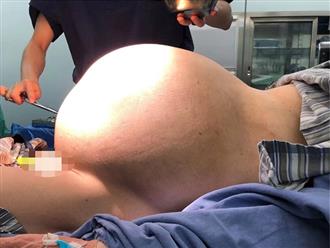 Bụng của người phụ nữ 56 tuổi to như đến ngày sinh, nghĩ rằng bị tăng cân nên đến bệnh viện kiểm tra và bàng hoàng với thứ được tìm thấy trong bụng