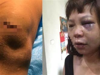 Phẫn nộ: Vợ bị chồng dùng dao cắt tóc và gân chân vì ghen tuông