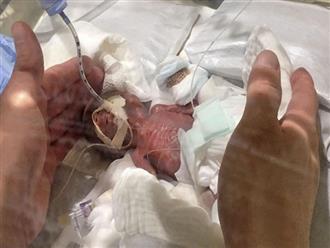 Nhật Bản: Cứu sống bé trai nhỏ nhất thế giới, khi chào đời chỉ nặng 268 gam