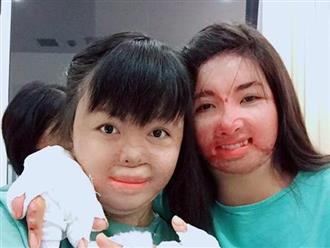 Gương mặt mới của cô gái 9x bị chồng dùng xăng thiêu sống, bệnh viện trả về vì chỉ còn 1% cơ hội sống