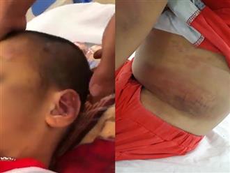 Tây Ninh: Mẹ ruột đánh đập con trai 6 tuổi bầm dập cả người
