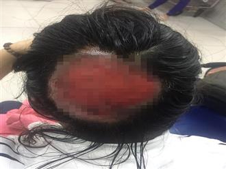 Nữ bác sĩ bị bỏng sâu, tróc gần như toàn bộ da đầu sau khi uốn tóc setting