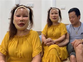 Vừa nâng mũi, cô dâu 62 tuổi tiếp tục thẩm mỹ căng da, gương mặt sưng phù sau phẫu thuật khiến nhiều người choáng váng