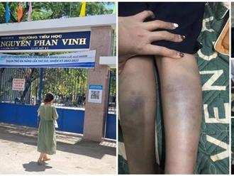 Thông tin MỚI vụ học sinh lớp 1 bị đánh bầm tím chân tay ở trường tại TP.Đà Nẵng 
