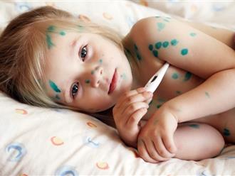 Bệnh thủy đậu ở trẻ em có nguy hiểm không? Biểu hiện và các chữa trị hiệu quả