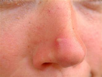 Những vị trí mụn trên mặt và dấu hiệu bệnh tật nguy hiểm liên quan