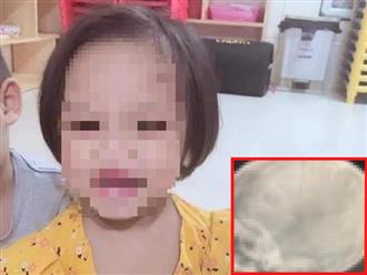 UBND Hà Nội hỏa tốc chỉ đạo xử lý nghiêm vụ cháu bé 3 tuổi nghi bị đóng đinh vào đầu