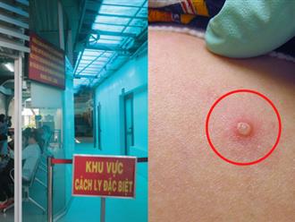 Tình hình sức khỏe của 9 người tiếp xúc gần với bệnh nhân nhiễm đậu mùa khỉ đầu tiên tại Việt Nam có đáng lo ngại?