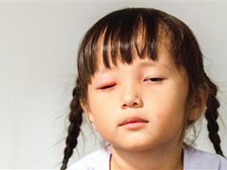 Để phòng tránh lây lan, bệnh nhân đau mắt đỏ cần "tuân thủ" 2 hành động này 