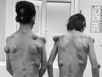 Mắc căn bệnh hiếm gặp, 2 anh em ở Tuyên Quang nổi hàng trăm khối u trên cơ thể