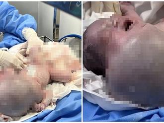 Phẫu thuật thành công cho bé sơ sinh mang khối bướu khổng lồ 1,1kg ngay khi vừa chào đời: 4 giờ đồng hồ đầy nghẹt thở