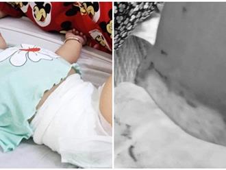 Đắk Lắk: Thương tâm đốt lò than gần giường ngủ, bé gái 7 tháng tuổi rơi xuống, bỏng nặng