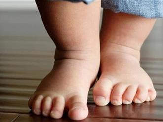 Một dấu hiệu ở bàn chân của con cảnh báo mắc phải dị tật mà 25% trẻ mắc phải