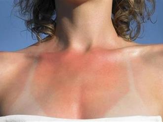 Nắng cháy da sau kì nghỉ lễ: 6 nguyên liệu thiên nhiên giúp bạn làm mềm, dịu tổn thương da tức thì không tốn 1 đồng