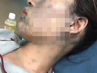 Thai phụ 22 tuần nhập viện vì mắc thủy đậu bội nhiễm: Làm gì để tránh nguy cơ?