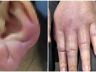 Bị lừa tiêm chất cấm silicon lỏng tạo 'tai Phật', tay búp măng, người phụ nữ bị biến chứng nặng, 'đau đến buốt óc'