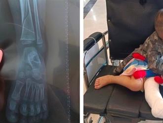 Hà Nội: Bé trai 2 tuổi bị ngã gãy chân trong lớp học, phụ huynh bức xúc vì nhà trường mập mờ, không trích xuất camera theo dõi