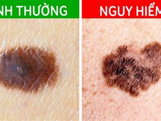 Cẩn trọng với '3 dấu hiệu đen' trên cơ thể cảnh báo ung thư: Số ca ở Việt Nam từ đứng thứ 3 đã tăng lên hàng 2