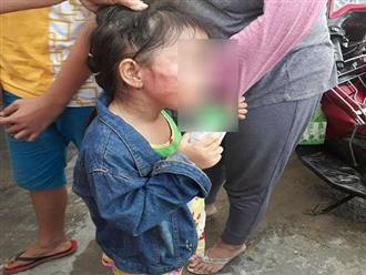 Quyết định gây ngỡ ngàng của gia đình bé gái 5 tuổi bị cô giáo tát nứt xương hàm 