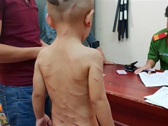 Không chịu ngủ trưa, bé trai 3 tuổi bị cha dượng đánh chi chít vết thương trên lưng