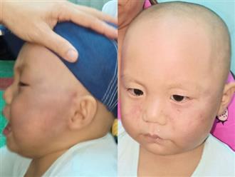 Dỗ mãi không nín, bé 19 tháng tuổi bị cô giáo đánh sưng mặt phải nhập viện
