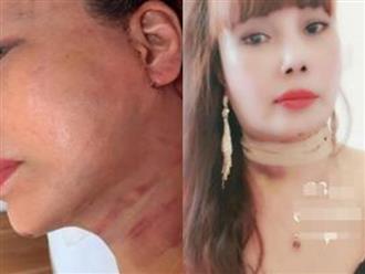Cô dâu 63 tuổi ở Cao Bằng khoe vết sẹo chạy dọc phần tai sau 1 tháng phẫu thuật căng da mặt khiến nhiều người "bủn rủn"