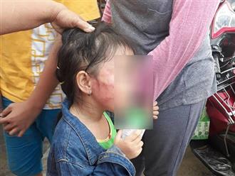 Cô giáo bạo hành bé 5 tuổi sưng mặt, tổn thương đầu: 'Do biếng ăn nên tát để bé sợ'