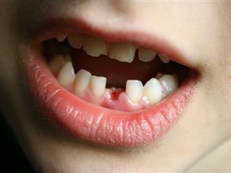 Bé trai 5 tuổi sau một đêm ngủ dậy rụng hết răng, nguyên nhân gây ra bởi "thủ phạm" quen mặt ai cũng biết nhưng đều xem nhẹ