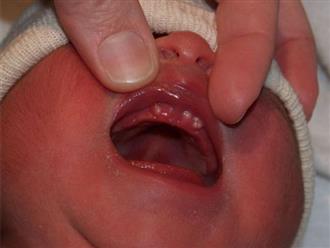 Các bác sĩ chỉ rõ cách xử lý răng nanh của trẻ sơ sinh