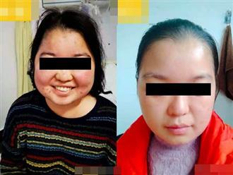 Cô gái 20 tuổi đột ngột tăng 10kg trong vài tháng, mặt nổi đầy mụn, cơ thể mọc nhiều lông do mắc hội chứng hiếm gặp