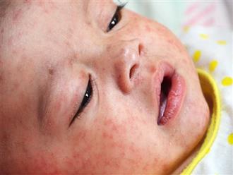 Con gái vật vã chiến đấu với bệnh sởi vì chưa được tiêm vắc xin, bà mẹ lên tiếng cảnh báo "Sởi có thể giết người"