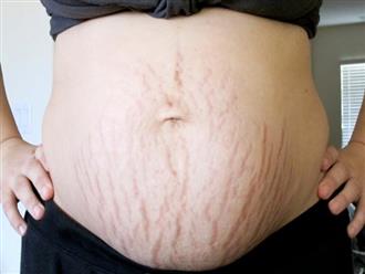 Rạn da lúc mang thai: Mẹ bầu chỉ cần làm mấy việc dễ ợt này là da lại đẹp như thời con gái