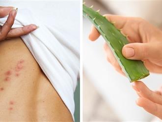 7 biện pháp khắc phục tình trạng ngứa da trong mùa hè tại nhà hiệu quả và cực kỳ an toàn