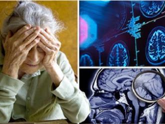 Bệnh Alzheimer ở ​​độ tuổi trung niên được chẩn đoán bằng protein não