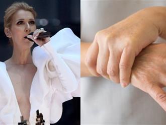 Căn bệnh hiếm khiến Celine Dion "có thể vĩnh viễn không đi hát trở lại" là bệnh gì?