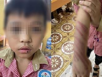 Hải Phòng: Bé trai 8 tuổi bị nhân tình của mẹ đánh đập dã man, cơ thể chằng chịt vết thương