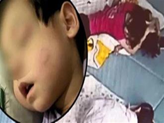 Con trai bị cô giáo mầm non "hôn" trong lúc ngủ để lại cả dấu răng, lời giải thích sau đó khiến bà mẹ không thể chấp nhận