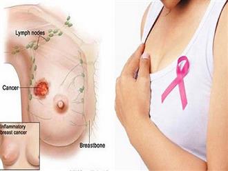 3 dấu hiệu điển hình cảnh báo ung thư vú đang ‘gõ cửa’ nhưng bạn thường hay bỏ qua