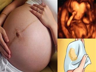 Viêm âm đạo ở mẹ bầu và những điều cần biết để không ảnh hưởng đến con