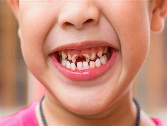 3 căn bệnh răng miệng nguy hiểm thường gặp ở trẻ nhỏ, bố mẹ chăm con tuyệt đối đừng nên chủ quan