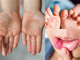 Bệnh chân tay miệng có lây sang người lớn không, những điều cần biết về bệnh