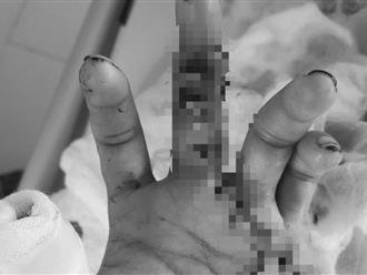 TP.HCM: Phẫu thuật nối ghép thành công 2 ngón tay đứt lìa cho nam thanh niên 33 tuổi