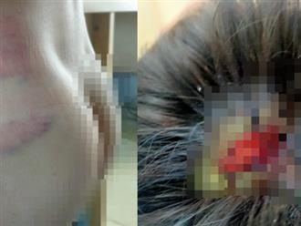 Gia Lai: Cha bạo hành con dã man, đánh đứa trẻ tét đầu vì kết quả thi học kỳ thấp