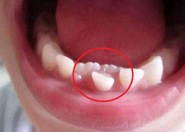 Cứ 10 trẻ thì có 5 trẻ bị hàm răng đôi do thói quen chiều con khi ăn của cha mẹ - Ảnh 1