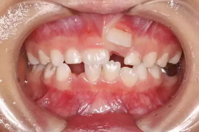 Cứ 10 trẻ thì có 5 trẻ bị hàm răng đôi do thói quen chiều con khi ăn của cha mẹ - Ảnh 3