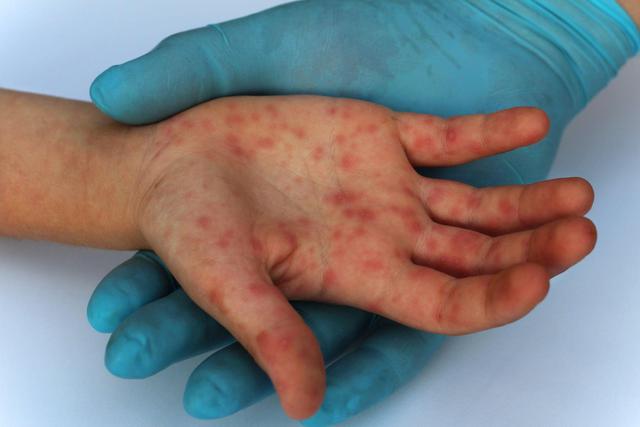 Bệnh đậu mùa khỉ: 5 điều bác sĩ muốn bạn biết để đảm bảo sự an toàn và sớm có cách đề phòng hiệu quả - Ảnh 4