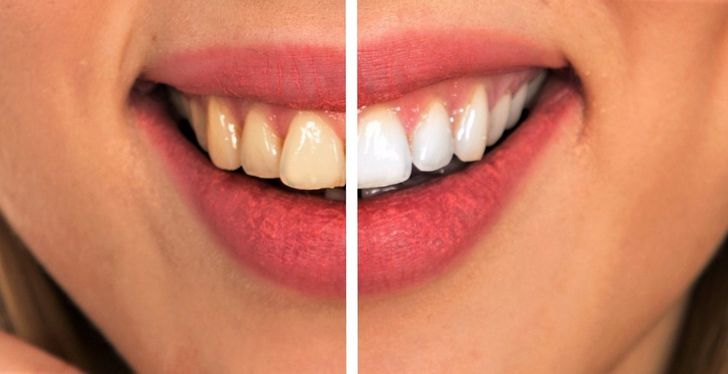 Đẩy lùi và chữa lành tình trạng sâu răng một cách tự nhiên với những biện pháp khắc phục tại nhà mà bạn có thể dễ dàng thực hiện  - Ảnh 3