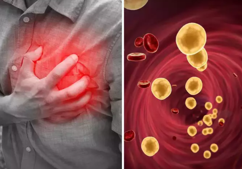 Cholesterol cao làm tăng nguy cơ mắc 5 bệnh cực nguy hiểm dẫn đến tử vong mà ai cũng sợ - Ảnh 3